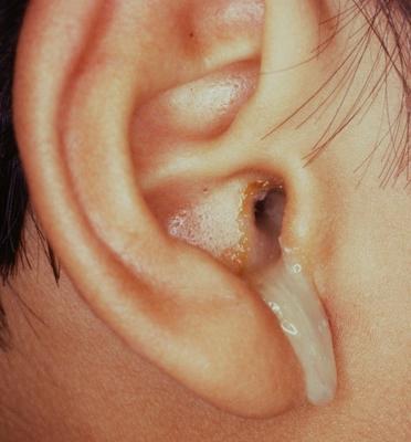 Comment utiliser correctement les gouttes pour les oreilles des enfants?