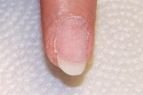 Pourquoi les ongles sont-ils fissurés? Causes possibles du problème