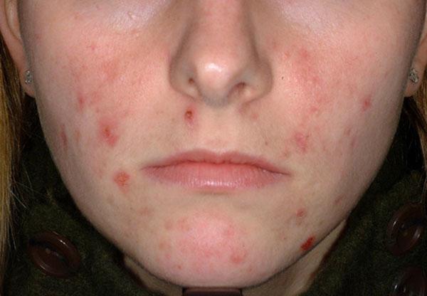 Apprenez à nettoyer l'acné