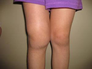 arthrose de l'articulation du genou