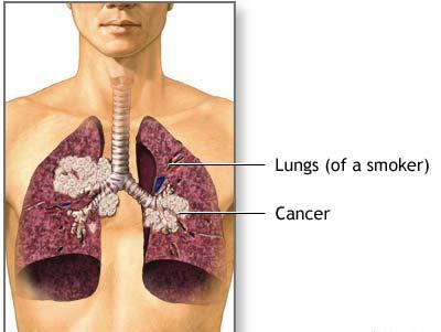 Cancer du poumon: combien vivent? Dois-je croire les prévisions?