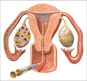 Stimulation de l'ovulation: examens, indications, caractéristiques de la procédure