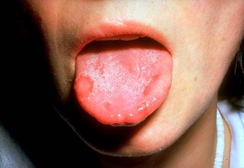 Stomatite chez les enfants: symptômes et traitement