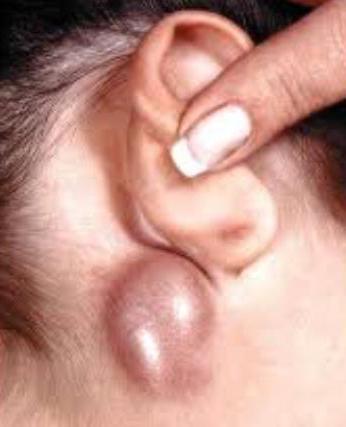 Est-ce que les lymphonodites derrière une oreille sont enflammés? L'essentiel est de combattre l'infection!